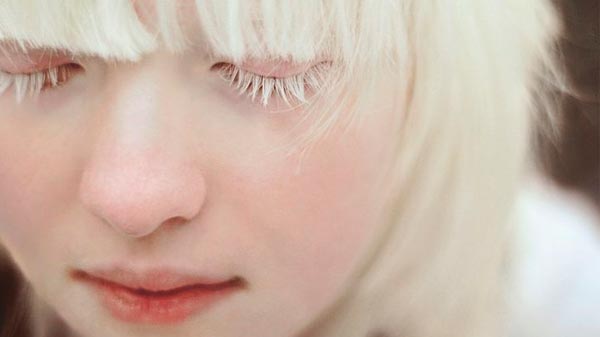 Media sanción al proyecto sobre tratamiento integral de las personas con albinismo