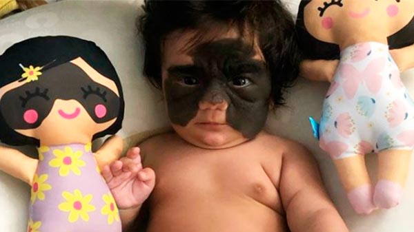 Una bebé se convirtió en estrella de Instagram con su marca de nacimiento