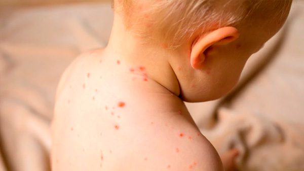 Dispusieron ampliar la vacunación contra el sarampión para niños de 6 a 11 meses