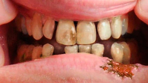 cancer bucal tabaco scapa de paraziti pentru totdeauna
