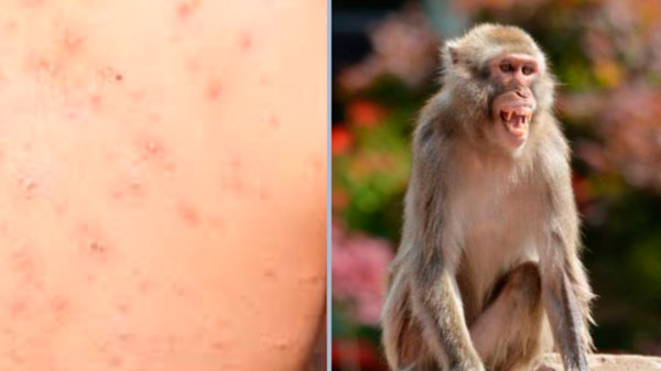 Paraguay reportó su primer caso sospechoso de viruela del mono