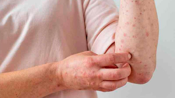Señalan que “no hay un antiviral” para la viruela del mono